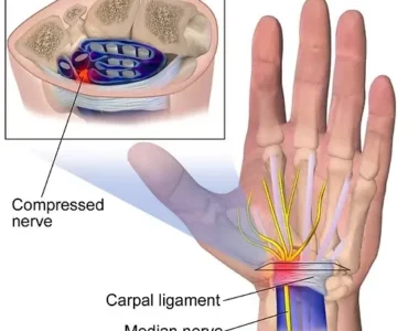 Carpal Tunnel Syndrome