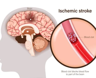 Ischemic Stroke