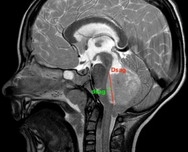 Posterior-Fossa-Tumor