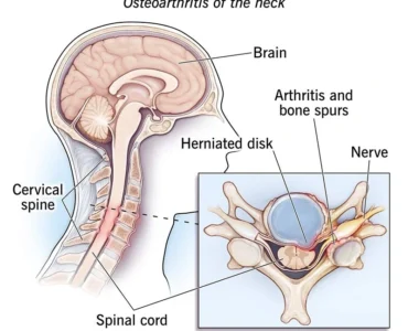 Cervical Spondylosis