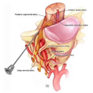 Epidural Nerveblock (TF Injections)