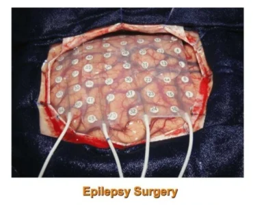 Epilepsy Surgery