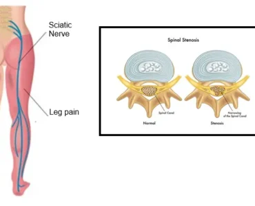 Lumbar Decompression Surgery