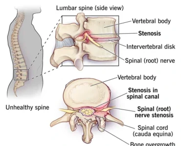 Spinal Stenosis