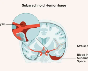 Subarachnoid Hemorrhage