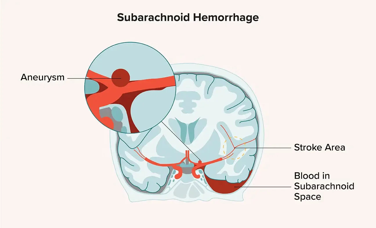 Subarachnoid Hemorrhage