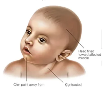Torticollis