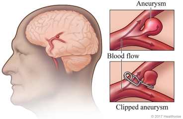Aneurysms Clipping Surgery