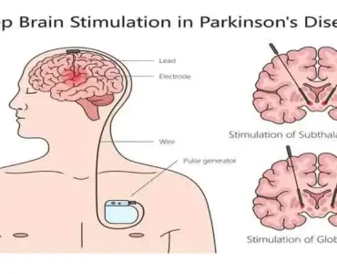 Parkinson's Disease