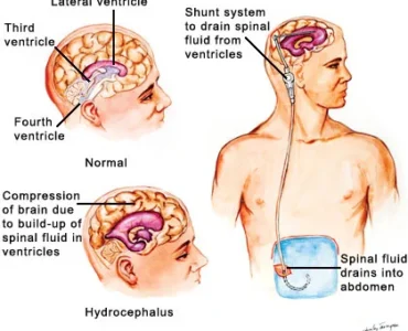 normal-pressure-hydrocephalus